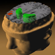 Шизофрения воздействует на мозг, снижая активность фронтальных долей (обозначены красным) при выполнении задач на рабочую память и повышая дофаминовую активность в стриатуме (показано зелёным) (иллюстрация Andreas Meyer-Lindenberg, NIMH Clinical Brain Disorders Branch).