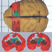3D-реконструкция того, как через 4 месяца после внедрения локализовались в мозгу клетки, помеченные зелёным флуоресцентным красителем. Чёрными стрелками обозначены точки инъекций (иллюстрация Jean-François Brunet et al.).