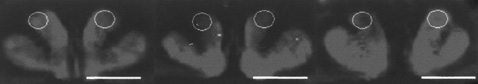 Инфракрасные снимки: полосатого тела нормального мозга, дофамин-обеднённого и через 4 месяца после реимплантации клеток. В круге белым отмечена иммунновосстановительная активность (фото Jean-François Brunet et al.).