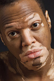 По утверждениям специалистов из Avita Medical, ReCell помогает и в лечении витилиго (<a href="http://en.wikipedia.org/wiki/Vitiligo">vitiligo</a>), заболевания кожи, при котором нарушается её пигментация (фото с сайта smh.com.au).