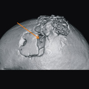 Трёхмерная томограмма головы испытуемого. Стрелкой показан провод, проникающий в твёрдую мозговую оболочку. Правее и выше виден набор электроники, установленной непосредственно на черепе, под кожей (фото Frank H. Guenther et al.).
