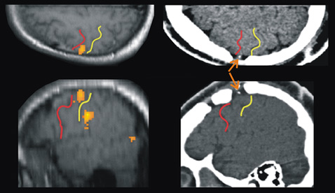 Слева: томограмма мозга, вид сверху и с левой стороны. Оранжевые пятна – активность нейронов в процессе попытки произнесения слов, красная линия – предцентральная борозда, жёлтая – центральная борозда. Справа: сканирование того же пациента после имплантации электродов (показаны стрелками) (фото Frank H. Guenther et al.).